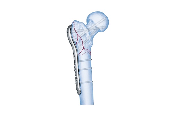 LCP Proximal Femoral Plate 4.55.0